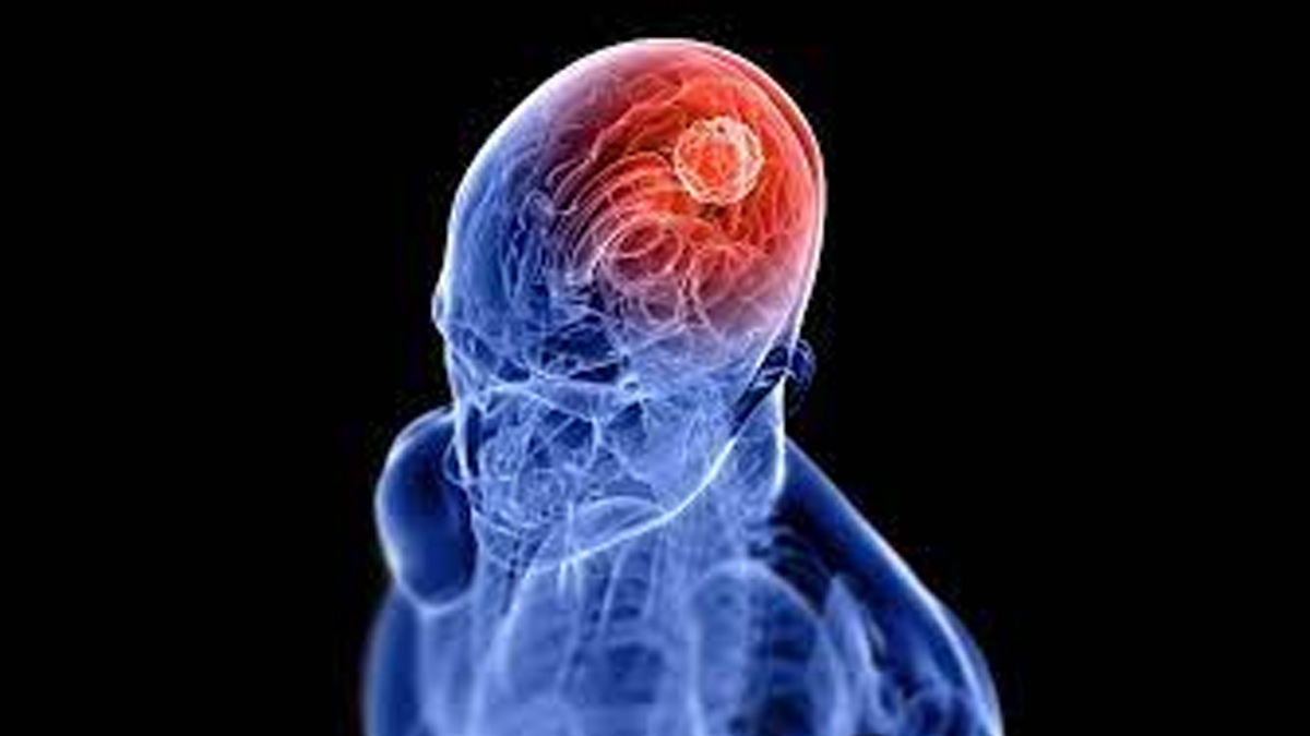 Antidepressant Could Help Fight Deadly Brain Tumours, Says Study